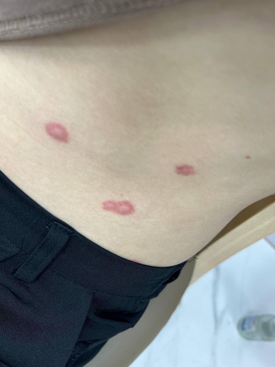 瓢虫求助：嫖完过后的几天，然后有一天洗澡，抓了下就这样了。让懂的兄弟帮忙看看，这是啥症状？